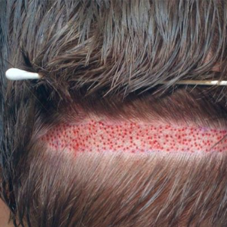 Besthybridhairtransplant